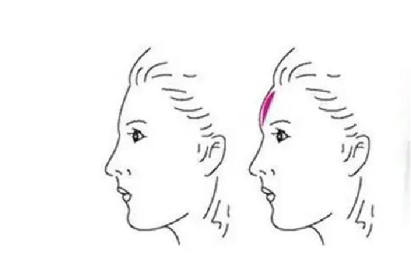 額頭填充玻尿酸需要幾支 額頭填充玻尿酸多久恢復(fù)正常 額頭填充玻尿酸需要幾支 額頭填充玻尿酸多久恢復(fù)正常