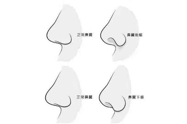 朝天鼻矯正一般多少錢 朝天鼻矯正風險大嗎 朝天鼻矯正一般多少錢 朝天鼻矯正風險大嗎