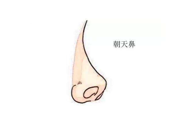 朝天鼻矯正一般多少錢 朝天鼻矯正風險大嗎 朝天鼻矯正一般多少錢 朝天鼻矯正風險大嗎