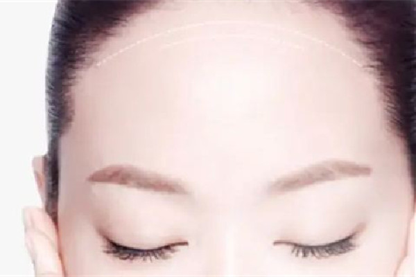 額頭填充一般要多少錢 額頭填充去什么醫(yī)院 額頭填充一般要多少錢 額頭填充去什么醫(yī)院