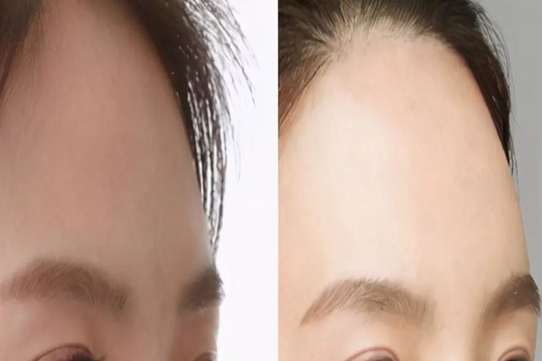 額頭填充是局麻還是全麻 額頭填充怎么做的 額頭填充是局麻還是全麻 額頭填充怎么做的