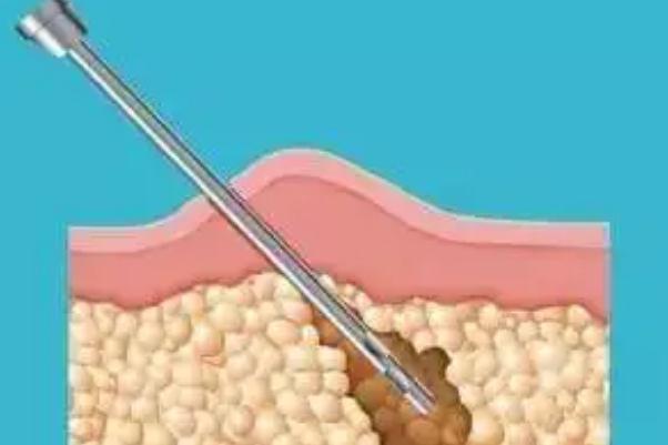 溶脂針的效果和副作用 溶脂針價(jià)格多少錢一針 溶脂針的效果和副作用 溶脂針價(jià)格多少錢一針