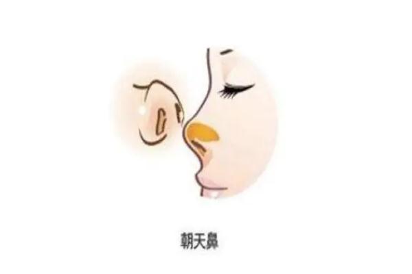 朝天鼻矯正一般多少錢 朝天鼻矯正風險大嗎 朝天鼻矯正一般多少錢 朝天鼻矯正風險大嗎