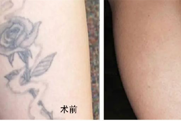 洗紋身要隔多久洗第二次 洗紋身按什么收費的 洗紋身要隔多久洗第二次 洗紋身按什么收費的