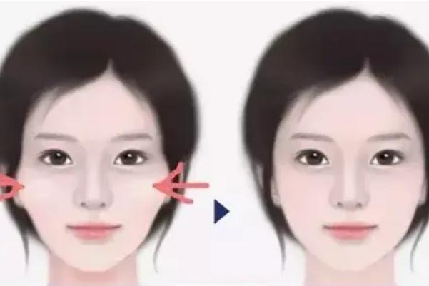 顴骨內推要開刀嗎 顴骨內推有生命危險嗎 顴骨內推要開刀嗎 顴骨內推有生命危險嗎