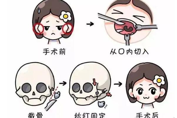 顴骨內(nèi)推和磨骨哪個風(fēng)險大 顴骨內(nèi)推的危害 顴骨內(nèi)推和磨骨哪個風(fēng)險大 顴骨內(nèi)推的危害