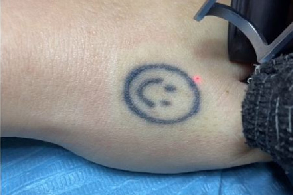 洗紋身一般要洗幾次才能干凈 洗紋身可以完全洗掉嗎 洗紋身一般要洗幾次才能干凈 洗紋身可以完全洗掉嗎