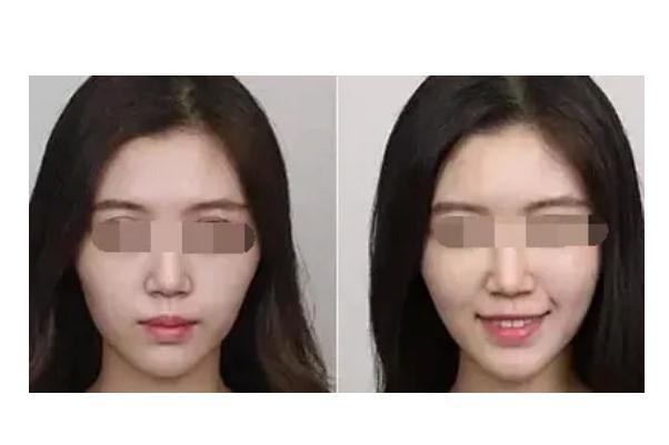 蘋果肌復(fù)位的注意事項(xiàng) 蘋果肌復(fù)位后要戴面罩嗎 蘋果肌復(fù)位的注意事項(xiàng) 蘋果肌復(fù)位后要戴面罩嗎