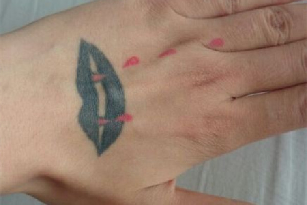 洗紋身會(huì)有增生疤痕嗎 洗紋身有點(diǎn)凸起來(lái)正常嗎 洗紋身會(huì)有增生疤痕嗎 洗紋身有點(diǎn)凸起來(lái)正常嗎