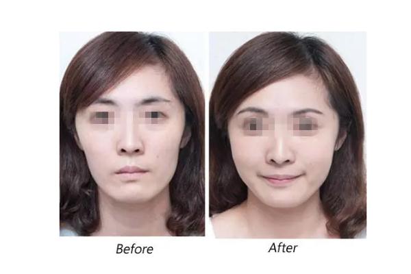 蘋果肌復(fù)位術(shù)多少錢 蘋果肌復(fù)位最好的辦法 蘋果肌復(fù)位術(shù)多少錢 蘋果肌復(fù)位最好的辦法