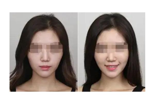 蘋果肌復(fù)位術(shù)多少錢 蘋果肌復(fù)位最好的辦法 蘋果肌復(fù)位術(shù)多少錢 蘋果肌復(fù)位最好的辦法