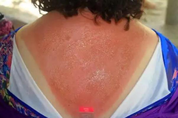 皮膚曬傷發(fā)紅怎么修復(fù) 皮膚曬傷怎么處理最好 皮膚曬傷發(fā)紅怎么修復(fù) 皮膚曬傷怎么處理最好