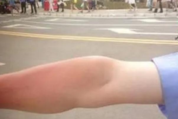 皮膚曬傷發(fā)紅怎么修復(fù) 皮膚曬傷怎么處理最好 皮膚曬傷發(fā)紅怎么修復(fù) 皮膚曬傷怎么處理最好