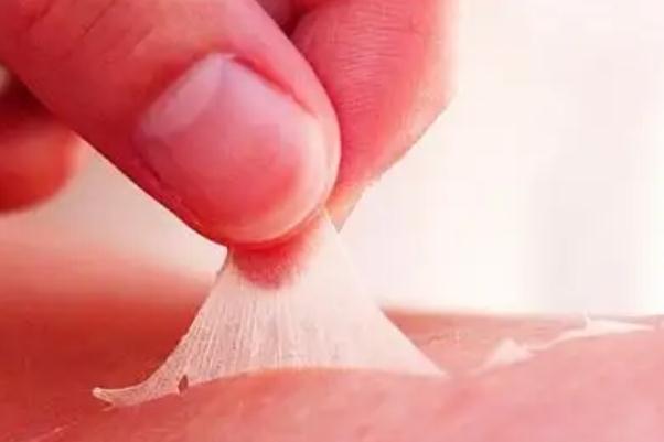 皮膚曬傷要注意什么 皮膚曬傷要去醫(yī)院嗎 皮膚曬傷要注意什么 皮膚曬傷要去醫(yī)院嗎