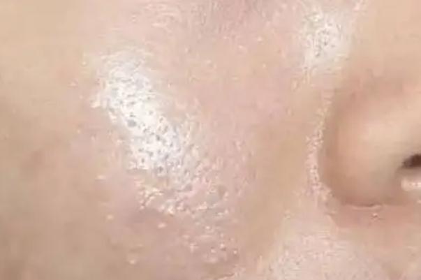 皮膚出油有臭味 皮膚出油有小顆粒 皮膚出油有臭味 皮膚出油有小顆粒