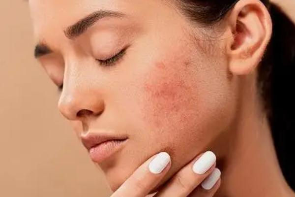 皮膚出油的表現(xiàn) 皮膚出油的好處 皮膚出油的表現(xiàn) 皮膚出油的好處