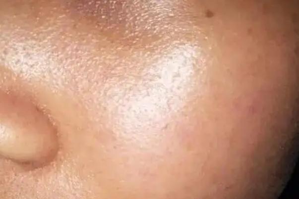 皮膚出油多是什么原因 皮膚出油嚴重毛孔粗大如何改善 皮膚出油多是什么原因 皮膚出油嚴重毛孔粗大如何改善