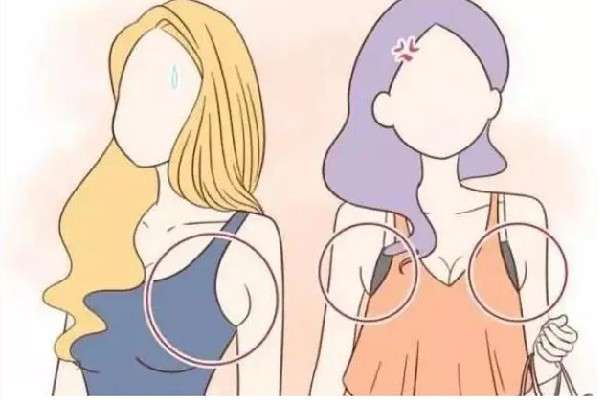 切副乳手術多少錢 切副乳手術可以報銷嗎