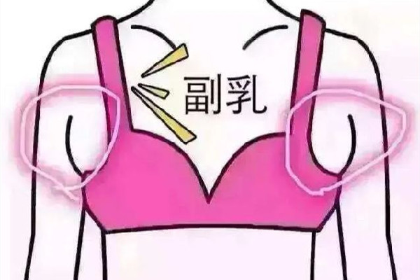 副乳切除手術(shù)會(huì)有疤痕嗎 副乳切除手術(shù)怎么才能看不到疤痕 副乳切除手術(shù)會(huì)有疤痕嗎 副乳切除手術(shù)怎么才能看不到疤痕