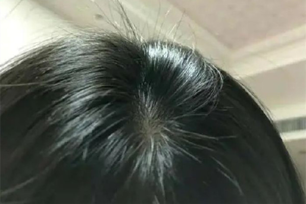 頭發(fā)出油要用什么洗發(fā)水 頭發(fā)出油用香皂洗頭可以嗎 頭發(fā)出油要用什么洗發(fā)水 頭發(fā)出油用香皂洗頭可以嗎