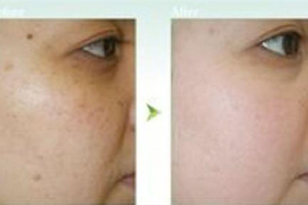 武漢去黑痣在哪里去比較好 武漢去黑痣可以用醫(yī)保嗎 武漢去黑痣在哪里去比較好 武漢去黑痣可以用醫(yī)保嗎