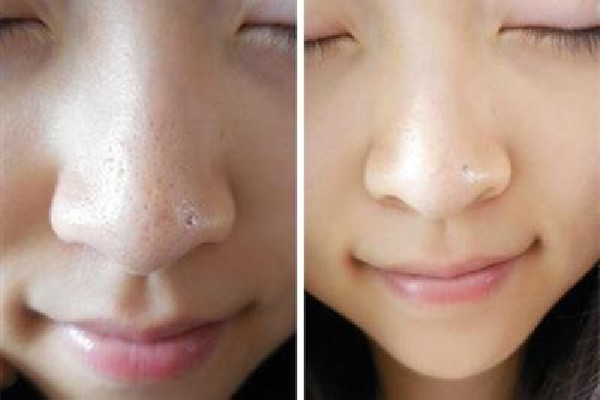 去黑頭后用什么修復 去黑頭后可以用爽膚水收縮毛孔嗎 去黑頭后用什么修復 去黑頭后可以用爽膚水收縮毛孔嗎