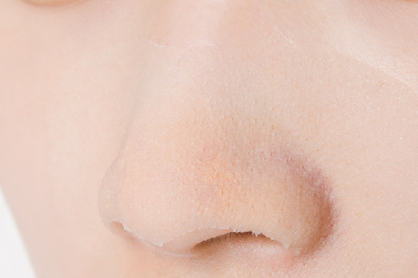 去黑頭后用什么修復 去黑頭后可以用爽膚水收縮毛孔嗎 去黑頭后用什么修復 去黑頭后可以用爽膚水收縮毛孔嗎