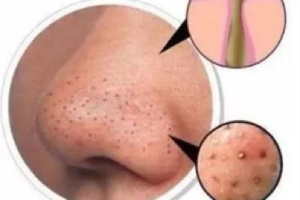 去黑頭在面膜前還是后 去黑頭什么時候時間去好 去黑頭在面膜前還是后 去黑頭什么時候時間去好