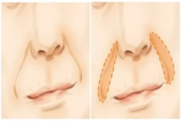 武漢玻尿酸填充哪家醫(yī)院好 武漢玻尿酸填充可以用醫(yī)保嗎 武漢玻尿酸填充哪家醫(yī)院好 武漢玻尿酸填充可以用醫(yī)保嗎