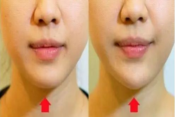 武漢墊下巴最好的醫(yī)院 武漢墊下巴多少錢 武漢墊下巴最好的醫(yī)院 武漢墊下巴多少錢