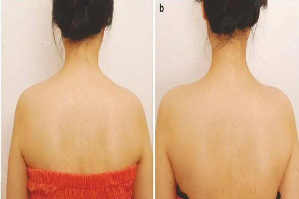 武漢打瘦肩針在哪里打 武漢瘦肩針打什么牌子的 武漢打瘦肩針在哪里打 武漢瘦肩針打什么牌子的