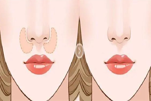 武漢墊鼻子哪個醫(yī)院好 武漢墊鼻子要多少錢 武漢墊鼻子哪個醫(yī)院好 武漢墊鼻子要多少錢