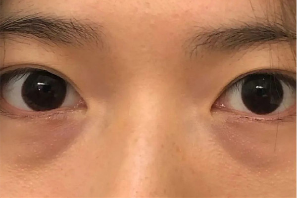 武漢哪家醫(yī)院去淚溝效果好 武漢去淚溝要花多少錢 武漢哪家醫(yī)院去淚溝效果好 武漢去淚溝要花多少錢