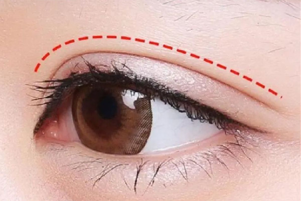 武漢雙眼皮埋線哪家醫(yī)院最好 武漢雙眼皮埋線價格 武漢雙眼皮埋線哪家醫(yī)院最好 武漢雙眼皮埋線價格