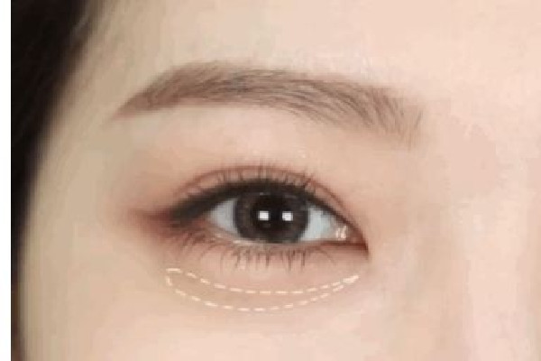 武漢填充臥蠶哪家好 武漢臥蠶手術(shù)哪個(gè)醫(yī)院做的好 武漢填充臥蠶哪家好 武漢臥蠶手術(shù)哪個(gè)醫(yī)院做的好