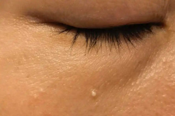 武漢去脂肪粒那家醫(yī)院比較好 武漢去脂肪粒多少錢 武漢去脂肪粒那家醫(yī)院比較好 武漢去脂肪粒多少錢