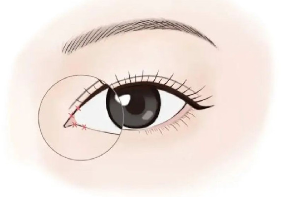 武漢整形眼睛修復(fù)哪家好 武漢眼部整形多少錢 武漢整形眼睛修復(fù)哪家好 武漢眼部整形多少錢