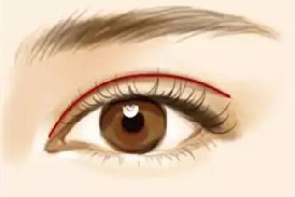 武漢眼瞼下垂手術(shù)哪個做的好 武漢眼瞼下垂手術(shù)要多少錢 武漢眼瞼下垂手術(shù)哪個做的好 武漢眼瞼下垂手術(shù)要多少錢