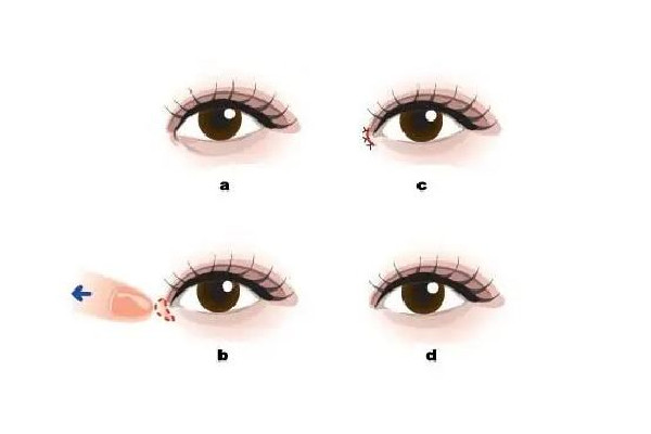 武漢開內(nèi)眼角醫(yī)院 武漢開內(nèi)眼角多少錢 武漢開內(nèi)眼角醫(yī)院 武漢開內(nèi)眼角多少錢