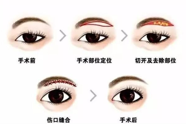 武漢提眉手術哪個醫(yī)院做的好 武漢提眉手術需要多少錢 武漢提眉手術哪個醫(yī)院做的好 武漢提眉手術需要多少錢