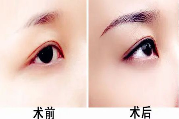 武漢提眉手術哪個醫(yī)院做的好 武漢提眉手術需要多少錢 武漢提眉手術哪個醫(yī)院做的好 武漢提眉手術需要多少錢