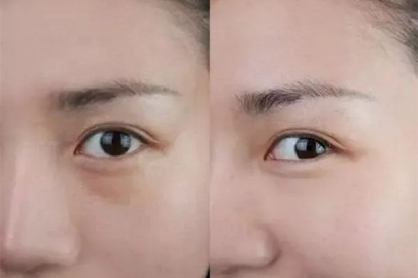 武漢下眼袋除皺手術(shù)多少錢 武漢下眼袋除皺手術(shù)去哪個(gè)醫(yī)院 武漢下眼袋除皺手術(shù)多少錢 武漢下眼袋除皺手術(shù)去哪個(gè)醫(yī)院