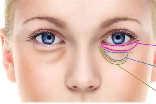 武漢下眼袋除皺手術(shù)多少錢 武漢下眼袋除皺手術(shù)去哪個(gè)醫(yī)院 武漢下眼袋除皺手術(shù)多少錢 武漢下眼袋除皺手術(shù)去哪個(gè)醫(yī)院