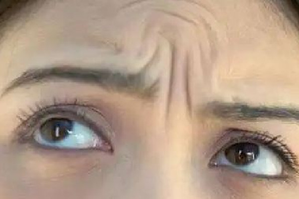 武漢去抬頭紋哪家好 武漢去抬頭紋多少錢 武漢去抬頭紋哪家好 武漢去抬頭紋多少錢