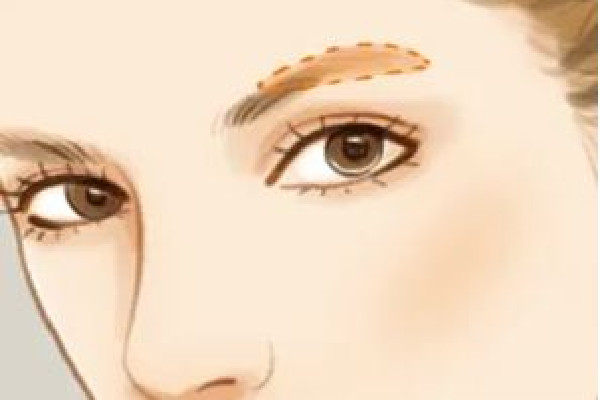 武漢做眉弓手術(shù)多少錢 武漢做眉弓手術(shù)去哪家醫(yī)院 武漢做眉弓手術(shù)多少錢 武漢做眉弓手術(shù)去哪家醫(yī)院