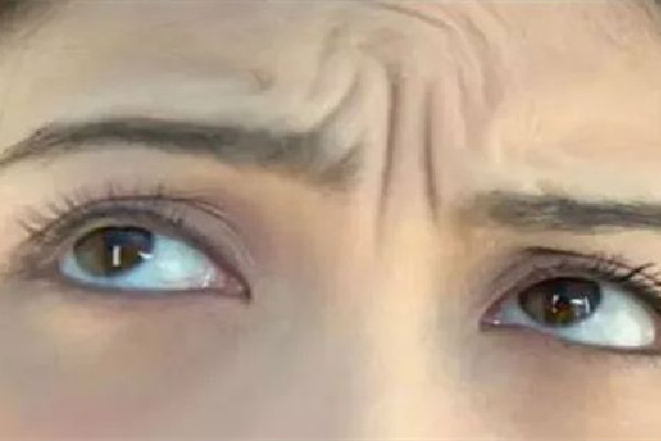 武漢眉間紋去除最好的醫(yī)院 武漢眉間紋去額頭皺紋的方法 武漢眉間紋去除最好的醫(yī)院 武漢眉間紋去額頭皺紋的方法