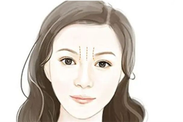 武漢去川字紋哪家美容醫(yī)院好 武漢去川字紋大概多少錢 武漢去川字紋哪家美容醫(yī)院好 武漢去川字紋大概多少錢