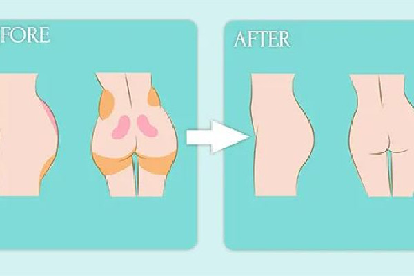 武漢假體臀部整形醫(yī)院 武漢假體臀部整形多少錢 武漢假體臀部整形醫(yī)院 武漢假體臀部整形多少錢