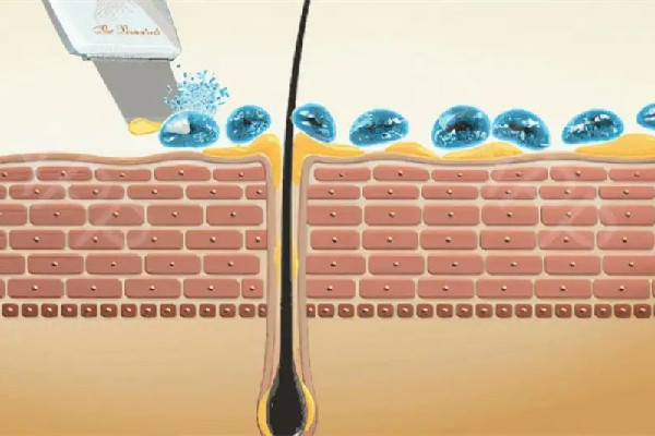 江漢路步行街skin79皮膚管理中心去黑頭效果怎么樣 江漢路步行街skin79皮膚管理中心可以深層清潔嗎 江漢路步行街skin79皮膚管理中心去黑頭效果怎么樣 江漢路步行街skin79皮膚管理中心可以深層清潔嗎