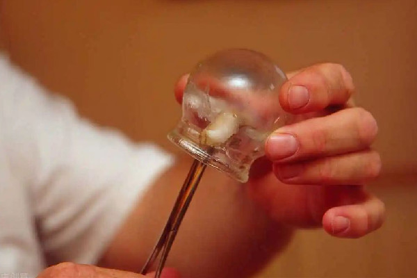 江漢路步行街溯美減肥美容養(yǎng)生拔罐項(xiàng)目怎么樣 拔罐對(duì)身體有什么樣的好處 江漢路步行街溯美減肥美容養(yǎng)生拔罐項(xiàng)目怎么樣 拔罐對(duì)身體有什么樣的好處